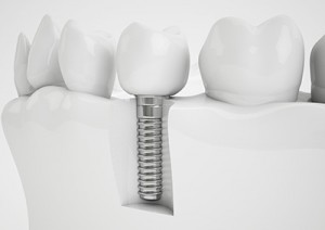 C2S Cabinet Dentaire - Implants